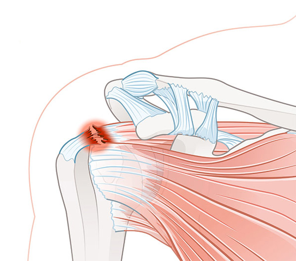 Supraspinatus Tendonitis