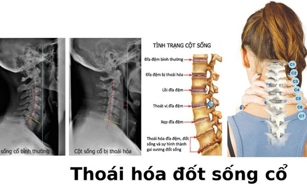 cervical spondylosis